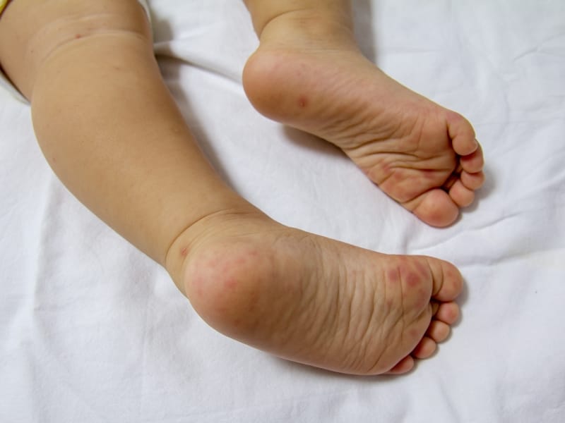 Dấu Hiệu Bé Bị Tay Chân Miệng, Ba Mẹ Nên Chú Ý Sớm!