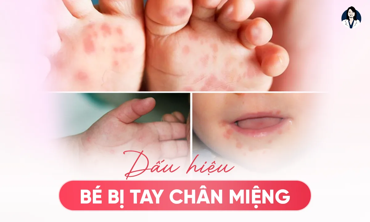 Dấu Hiệu Bé Bị Tay Chân Miệng, Ba Mẹ Nên Chú Ý Sớm!
