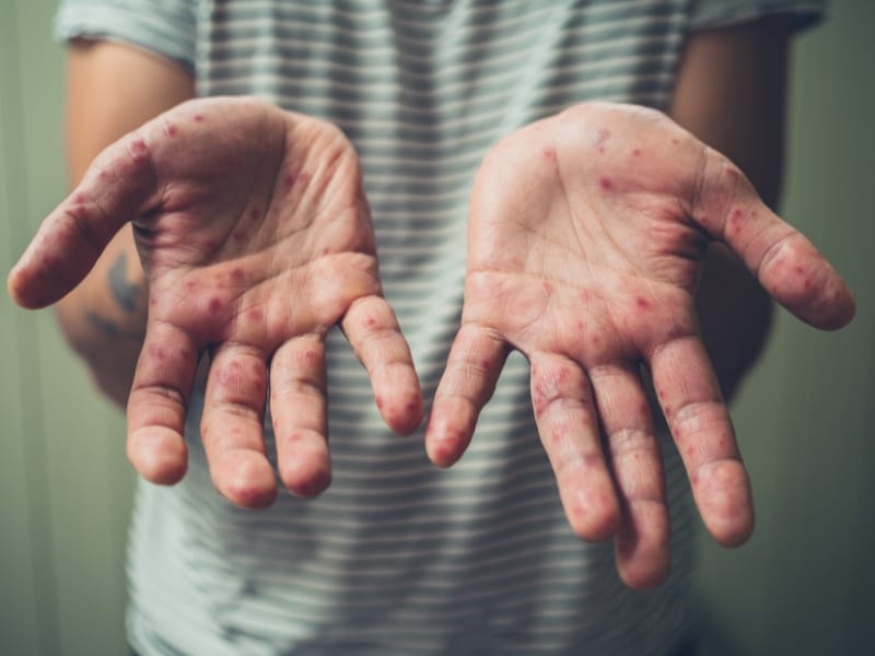 Dấu Hiệu Bé Bị Tay Chân Miệng, Ba Mẹ Nên Chú Ý Sớm!